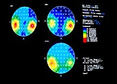 EEG maps of person controlling computer cursor