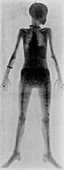 First whole body X-ray,1897