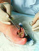 Surgeon placing maggots in a wound to clean it