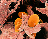 Scabies mite eggs in skin