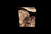 Triplet embryos, 3D ultrasound scan