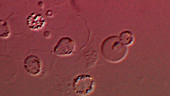 Malaria in the blood, microscopy