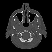 Axial MRT Nasal cavity