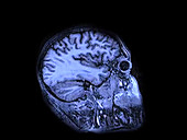 MRI brain scan sequence