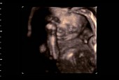 Foetus, 4D ultrasound scan