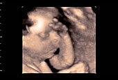 Foetus head, 4D ultrasound scan