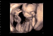 27 week old foetus, 4D ultrasound scan