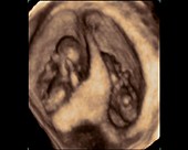 Twin foetuses, 4D ultrasound scan