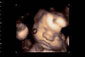 32 week old foetus, 4D ultrasound scan