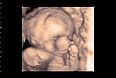 25 week old foetus, 4D ultrasound scan