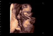 18 week old foetus, 4D ultrasound scan