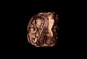 Foetus, 3D ultrasound scan