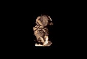 14 week old foetus, 3D ultrasound scan