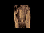 Foetus, 3D ultrasound scan