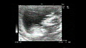 Twins, ultrasound scan