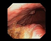 Stomach cancer, endoscope view
