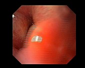 Human larynx, endoscope view