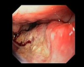 Stomach cancer biopsy, endoscope view