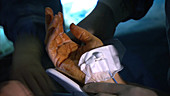 Patient's hand in surgery