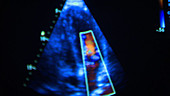 Echocardiogram on a monitor