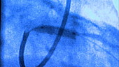 Screen showing cardiac angiogram