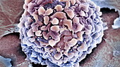 Rectal cancer cell, SEM