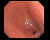 Premalignant colonic growth