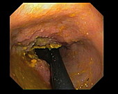 Gastric cancer