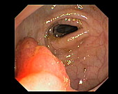 Premalignant colonic growth removal