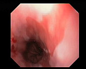 Barrett's oesophagus , endoscope view
