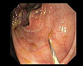Premalignant colonic growth removal