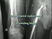 Total femoral replacement