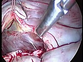 Keyhole mitral valve surgery