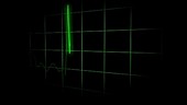 ECG heart trace