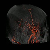Brain blood vessels, CT scan
