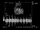 Foetal ultrasound scan with heartbeat