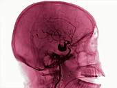 Aneurysm in the brain, angiography