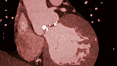 Damaged aortic valve, CT angiography