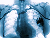 Pacemaker and defibrillator, angiography