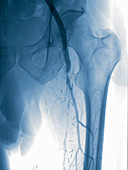 Angioplasty, angiography