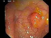 Premalignant rectal growth removal