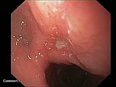 Intestinal ulcer, endoscope view