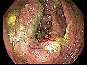 Caecal cancer, endoscope view