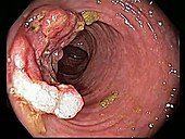 Rectal cancer, endoscope view