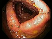 Large intestine, endoscope view