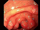 Gastritis, endoscope view