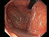 Atrophic gastritis, endoscope view
