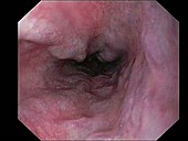 Oesophageal varicose veins endoscope view