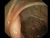 Lymphoid hyperplasia, endoscope view
