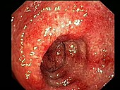 Ulcerative colitis, endoscope view